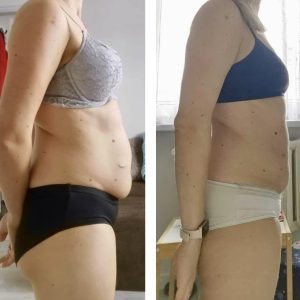 metamorfozy przed i po aplikacja miazga 00001