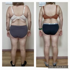 metamorfozy przed i po aplikacja miazga 00003