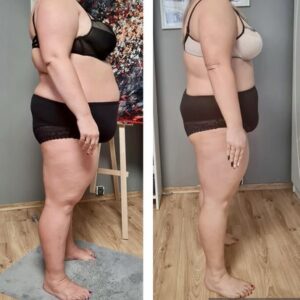 metamorfozy przed i po aplikacja miazga 00005