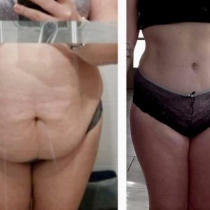 metamorfozy przed i po aplikacja miazga 00009