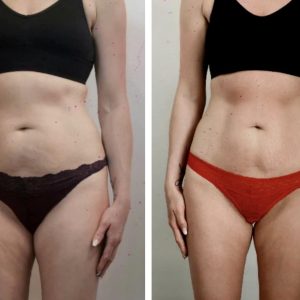 metamorfozy przed i po aplikacja miazga 00011