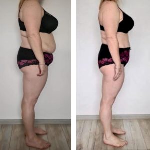 metamorfozy przed i po aplikacja miazga 00012