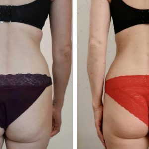 metamorfozy przed i po aplikacja miazga 00013