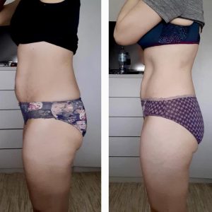 metamorfozy przed i po aplikacja miazga 00015