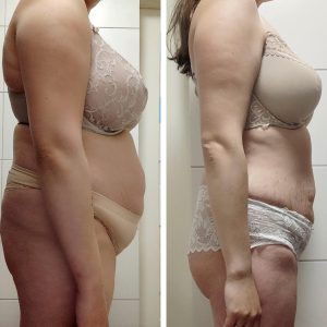 metamorfozy przed i po aplikacja miazga 00016