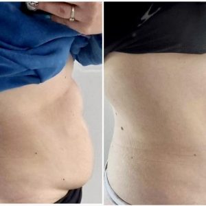 metamorfozy przed i po aplikacja miazga 00021