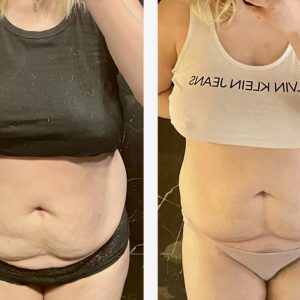 metamorfozy przed i po aplikacja miazga 00023