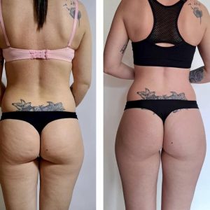 metamorfozy przed i po aplikacja miazga 00026