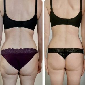 metamorfozy przed i po aplikacja miazga 00027