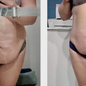 metamorfozy przed i po aplikacja miazga 00029