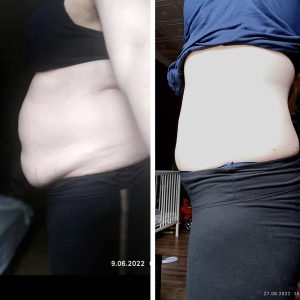 metamorfozy przed i po aplikacja miazga 00031