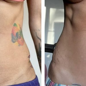 metamorfozy przed i po aplikacja miazga 00033