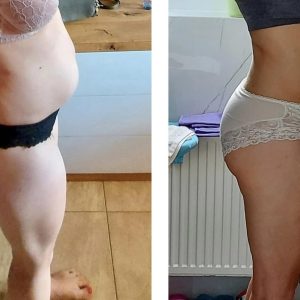 metamorfozy przed i po aplikacja miazga 00035