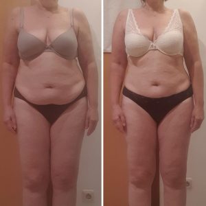 metamorfozy przed i po aplikacja miazga 00054