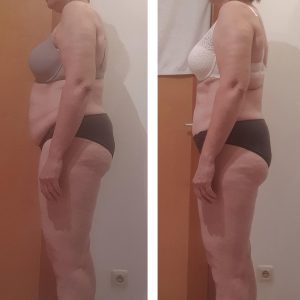 metamorfozy przed i po aplikacja miazga 00055