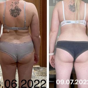 metamorfozy przed i po aplikacja miazga 00062