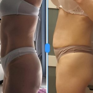 metamorfozy przed i po aplikacja miazga 00065