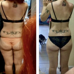 metamorfozy przed i po aplikacja miazga 00070