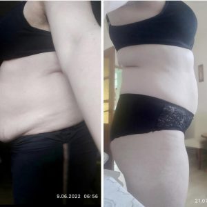 metamorfozy przed i po aplikacja miazga 00072