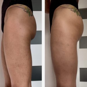 metamorfozy przed i po aplikacja miazga 00073