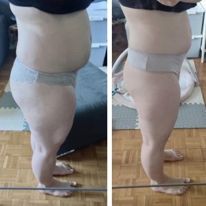 metamorfozy przed i po aplikacja miazga 00095