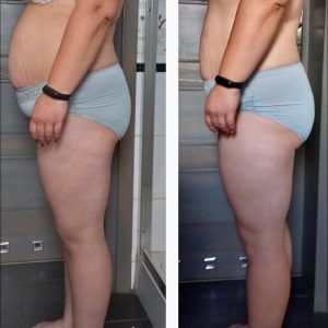 metamorfozy przed i po aplikacja miazga 00100