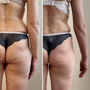 metamorfozy przed i po aplikacja miazga 00106