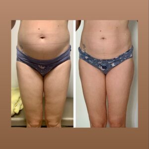 metamorfozy przed i po aplikacja miazga 00108