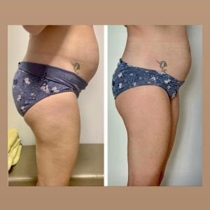 metamorfozy przed i po aplikacja miazga 00110