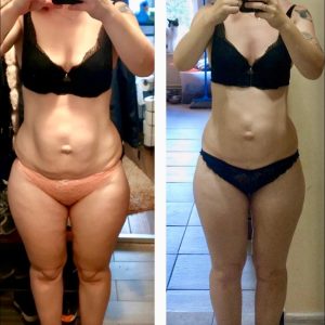 metamorfozy przed i po aplikacja miazga 00113