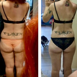 metamorfozy przed i po aplikacja miazga 00116