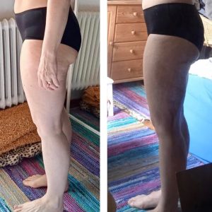 metamorfozy przed i po aplikacja miazga 00120