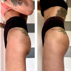 metamorfozy przed i po aplikacja miazga 00123