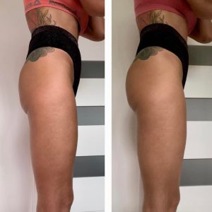 metamorfozy przed i po aplikacja miazga 00125