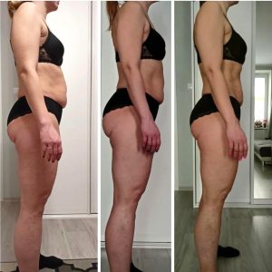 metamorfozy przed i po aplikacja miazga 00146