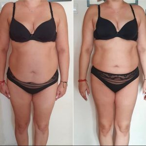 metamorfozy przed i po aplikacja miazga 00149