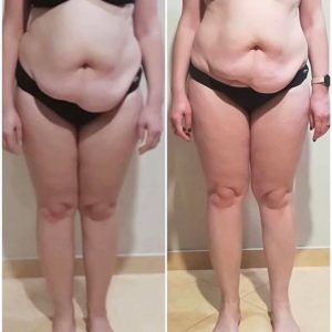 metamorfozy przed i po aplikacja miazga 00152