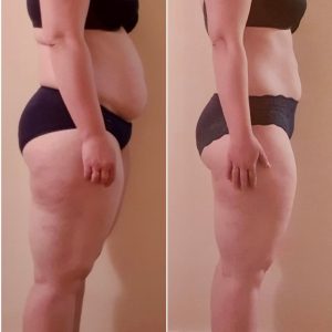 metamorfozy przed i po aplikacja miazga 00156