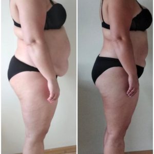 metamorfozy przed i po aplikacja miazga 00159