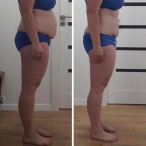 metamorfozy przed i po aplikacja miazga 00163