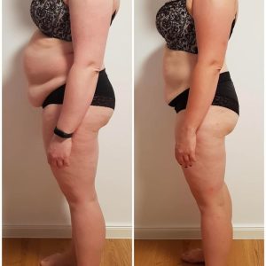 metamorfozy przed i po aplikacja miazga 00165