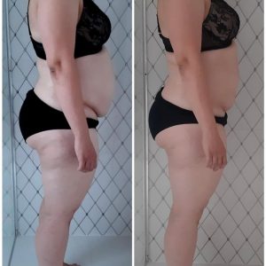 metamorfozy przed i po aplikacja miazga 00166