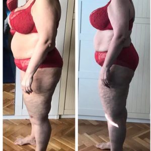 metamorfozy przed i po aplikacja miazga 00169