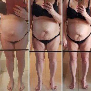 metamorfozy przed i po aplikacja miazga 00170