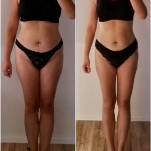 metamorfozy przed i po aplikacja miazga 00171