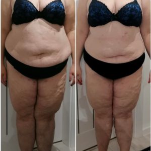 metamorfozy przed i po aplikacja miazga 00174