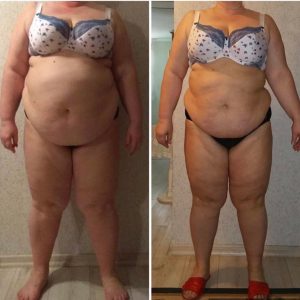 metamorfozy przed i po aplikacja miazga 00175