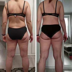 metamorfozy przed i po aplikacja miazga 00176