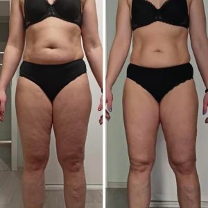 metamorfozy przed i po aplikacja miazga 00177