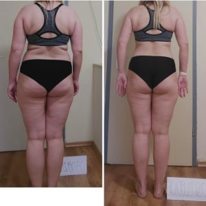 metamorfozy przed i po aplikacja miazga 00182